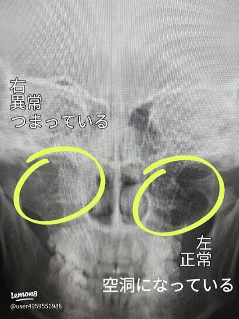 【画像】蓄膿症、顔の中がヤバイ状態になってしまう・・・・・ | 【画像】蓄膿症、顔の中がヤバイ状態になってしまう・・・・・ | 【画像】蓄膿症、顔の中がヤバイ状態になってしまう・・・・・ | 【画像】蓄膿症、顔の中がヤバイ状態になってしまう・・・・・ | 【画像】蓄膿症、顔の中がヤバイ状態になってしまう・・・・・ | やっちまった速報(画像02031745127972_5)