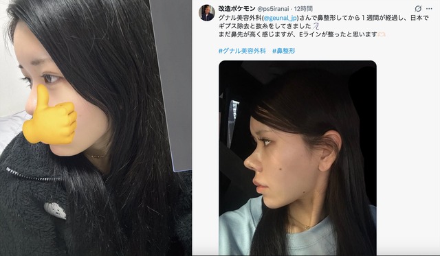 【画像】女さんの『鼻整形』、すごいｗｗｗｗｗｗ | 【画像】女さんの『鼻整形』、すごいｗｗｗｗｗｗ | やっちまった速報(画像24001901455263_2)